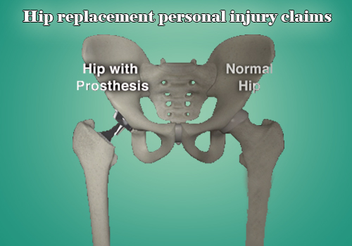 Hip replacement personal injury claims